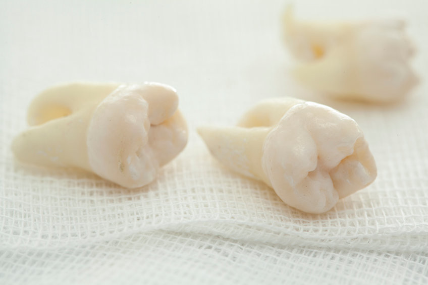 9 zaleceń po usunięciu zęba