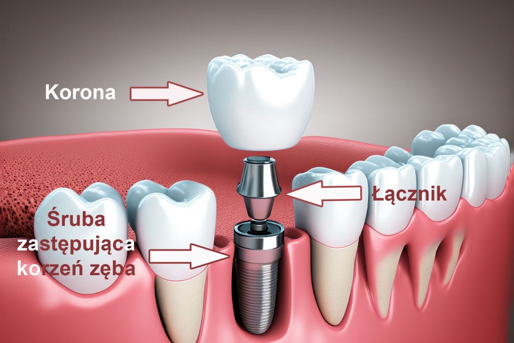 dental implantation, with a focus on the implant screw that is used to support a replacement tooth. The image features a close-up of a set of teeth, with one tooth highlighted as the focus of the image.