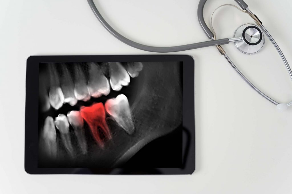 Dentist dental tool to teeth x-ray work Looking At Teeth X-ray On Computer